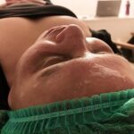 Peeling Enzimático